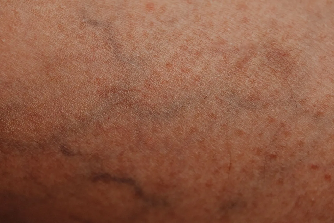 Schnittnarben bei der Bruststraffung: Erwartungen und Realitäten